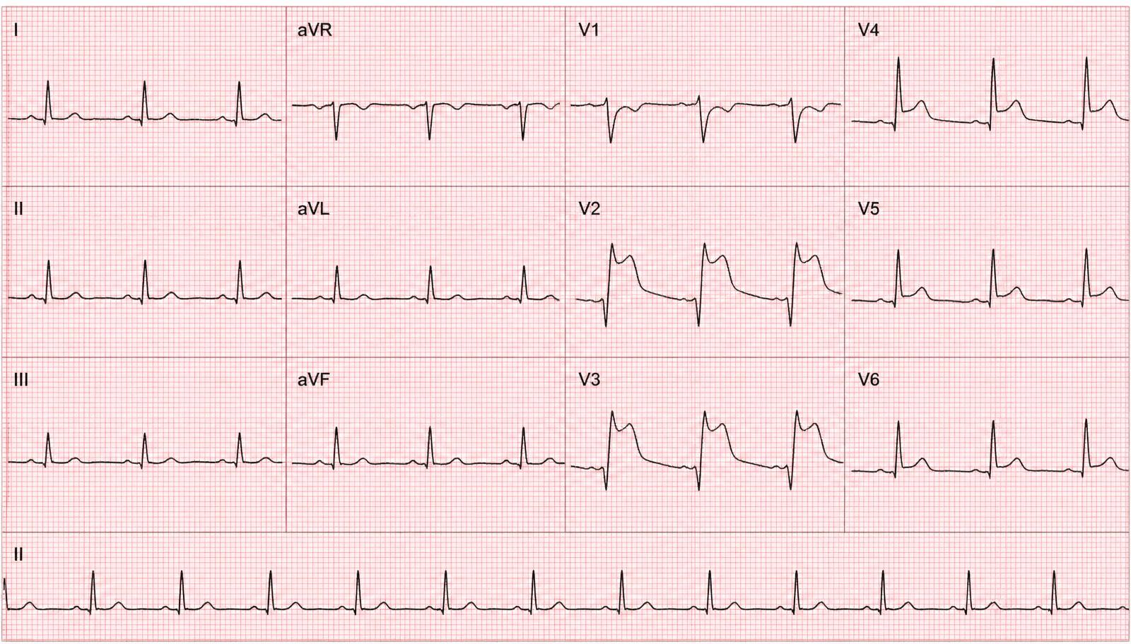 ECG de 12 derivações com supradesnivelamento do segmento ST em V2, V3 e V4